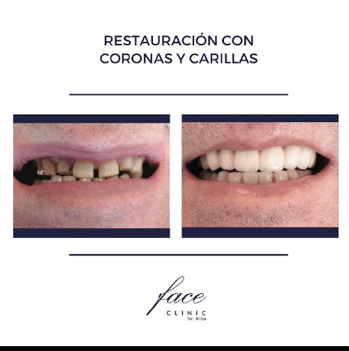 Restauración dental antes y después