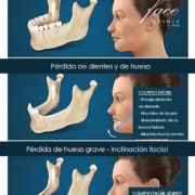 Pérdida de dientes en adultos