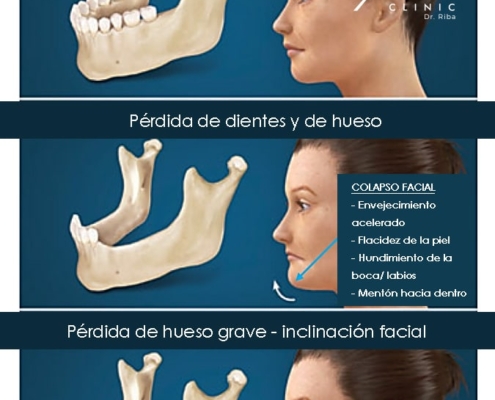 Pérdida de dientes en adultos