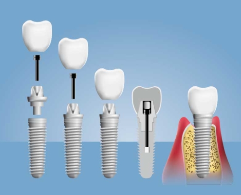 Implante osteointegrado