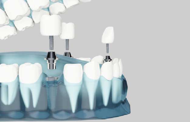 Implantes dentales en un día precio