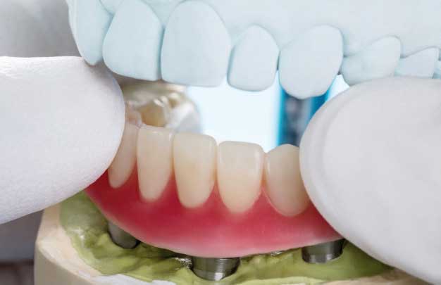 Implantes dentales en un día en toda la boca