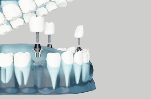 Implantes vs puentes dentales