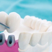 ¿Qué es mejor un puente dental o un implante dental?