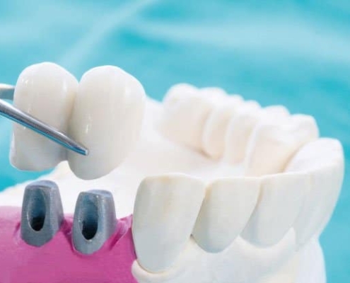 ¿Qué es mejor un puente dental o un implante dental?