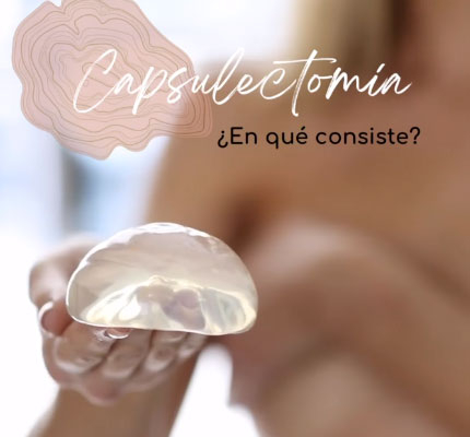 Capsulectomía