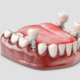 ¿Cuántos implantes dentales se pueden poner en un día?