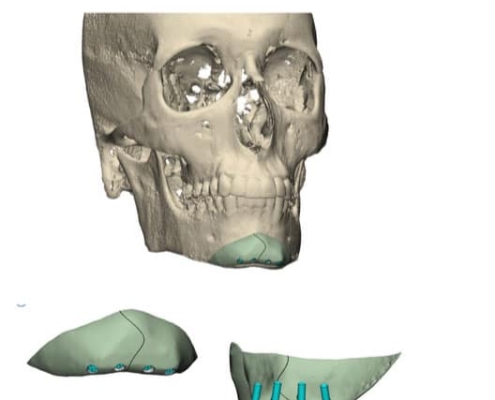 La customización de los implantes llega a la cirugía estética facial