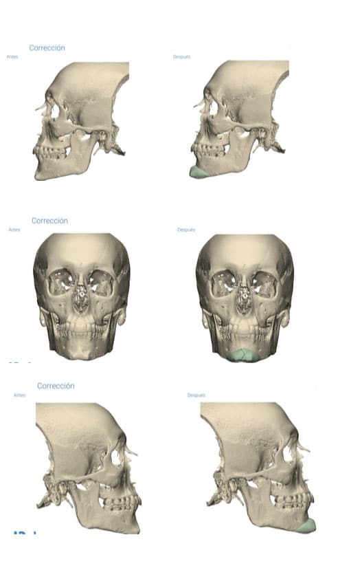 La customización de los implantes llega a la cirugía facial 