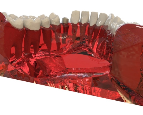 ¿Cómo afectan los implantes dentales a nuestra salud?