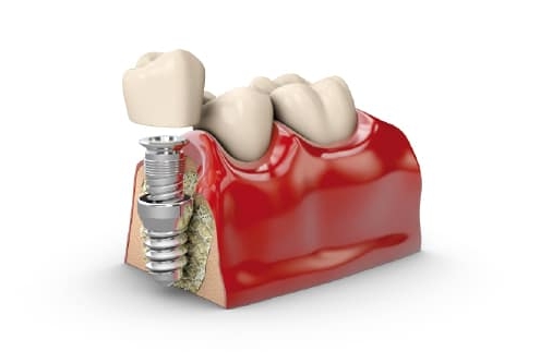 ¿Por qué se aflojan las coronas de los implantes?