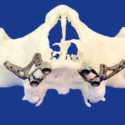 Implantes dentales sin tornillos