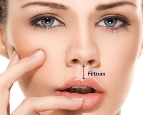 Filtrum labial