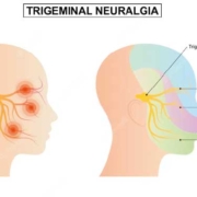 Nervio trigémino