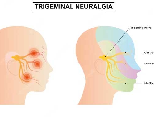 Nervio trigémino