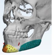 Eliminar papada con implantes faciales