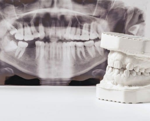 Osteotomia Dental