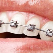 Tratamiento del bruxismo con ortodoncia
