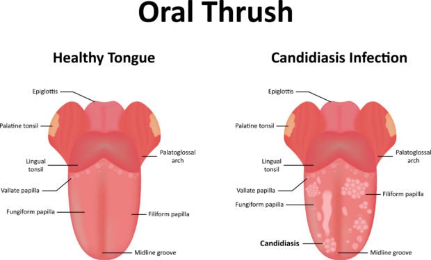 Candidiasis Oral
