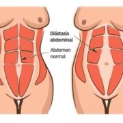 Cómo reducir cintura - Diastasis