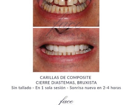 Diastema antes y después