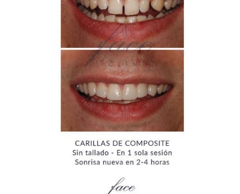 Diastema antes y después - Face Clinic