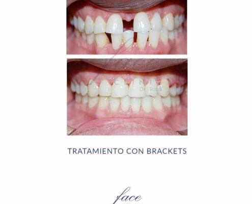 Diastema dental