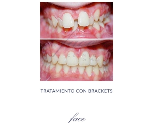 Diastemas antes y después