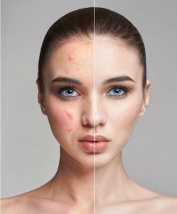 Quitar marcas de acné
