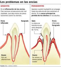 Encías inflamadas