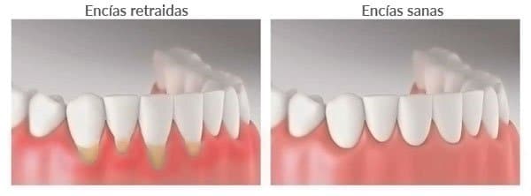 Encías retraídas tratamientos