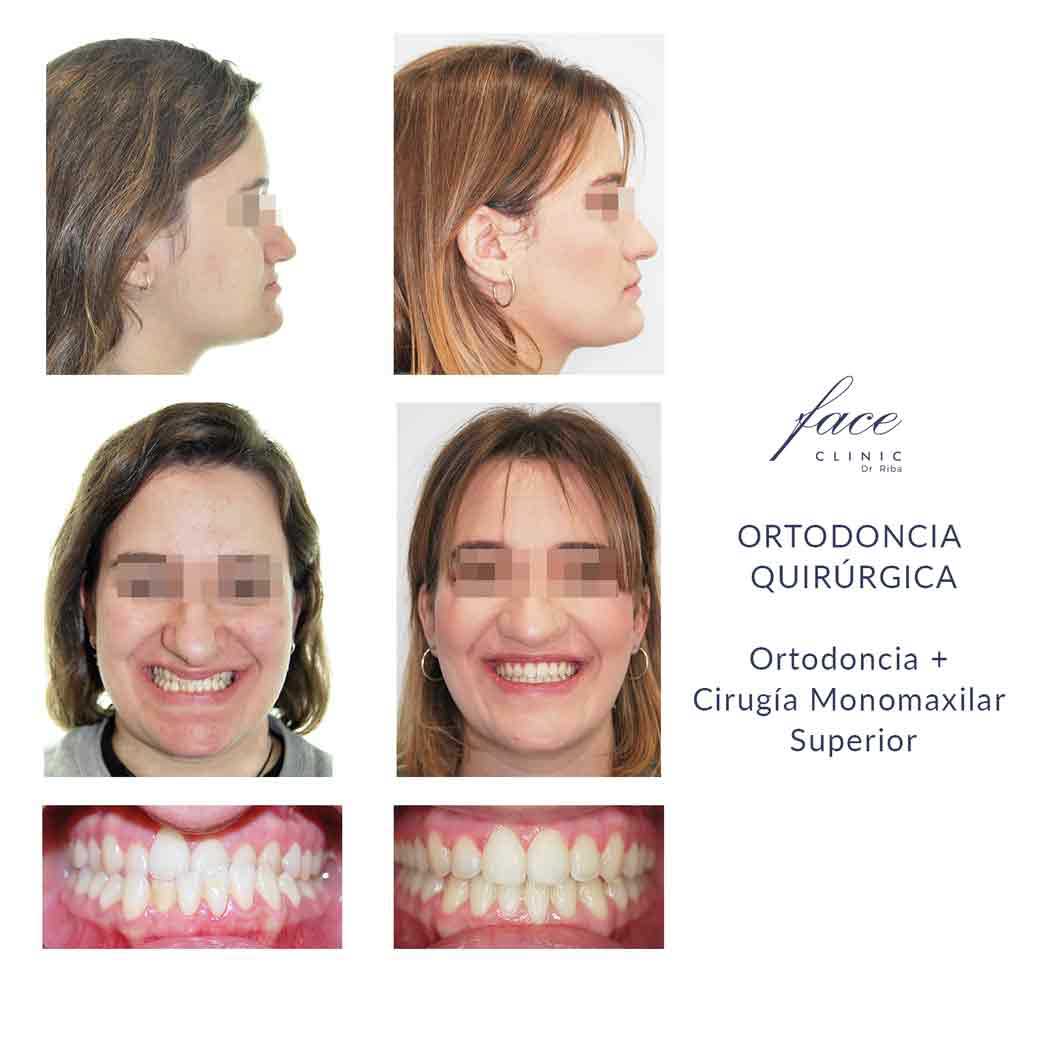 Maloclusión dentales antes y después