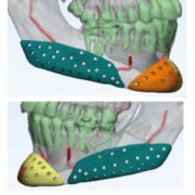 Perfilado de mandíbula - Implantes