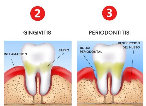 Periodontitis