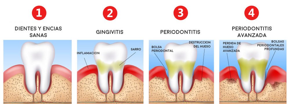 Periodontitis