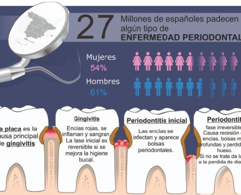 Piorrea