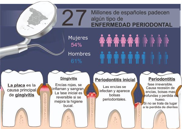 Piorrea