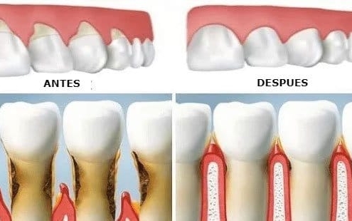 Regeneración de encías