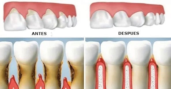 Regeneración de encías