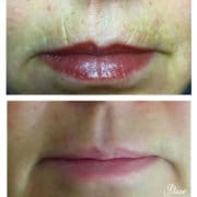 Tratamientos estéticos labios - Rejuvenecimiento