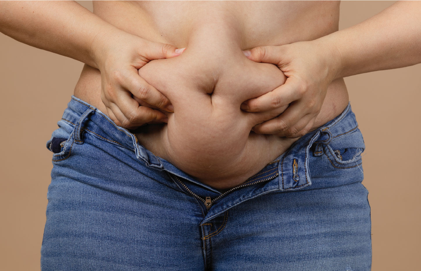 Abdominoplastia en flor de lys