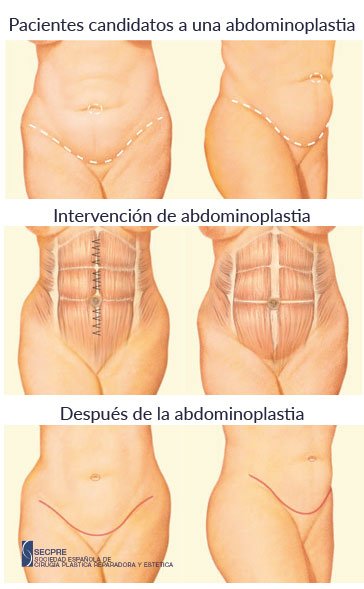Abdominoplastia operación