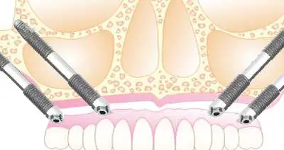 Clínica de implantes cigomáticos en Madrid