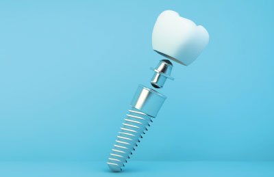 Clínica implantes dentales Pozuelo y Aravaca
