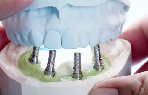 Clínica implantes dentales en Salamanca