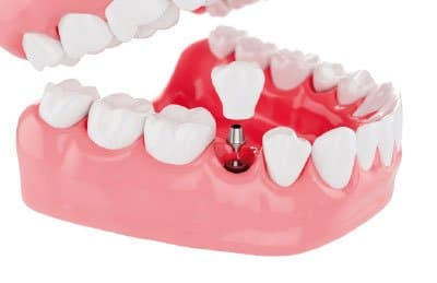 Clínica de implantes dentales en Valladolid