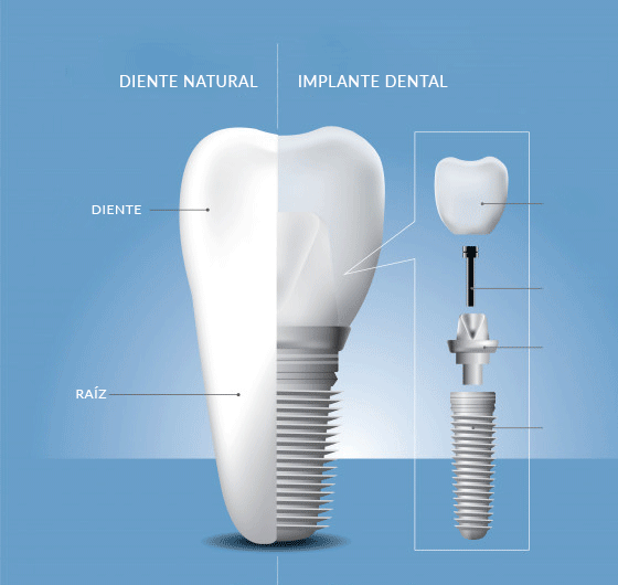 Implante dental