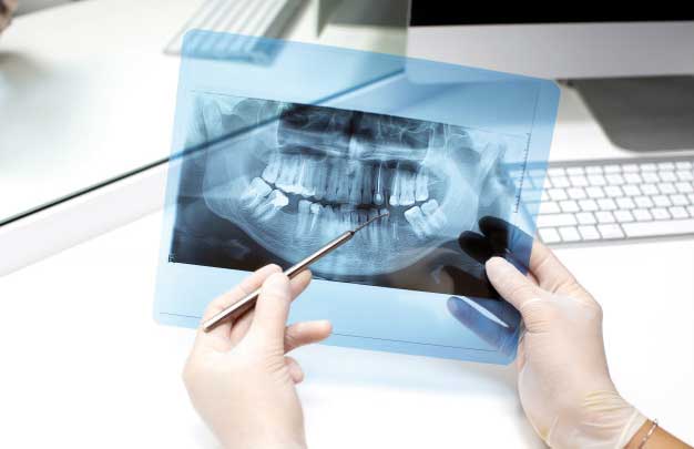 Estudio implantológico