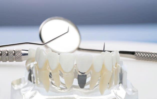 Implante dental en Madrid