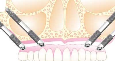 Implantes cigomáticos indicaciones